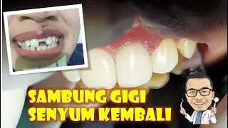 Sambung gigi depan patah akibat kecelakaan (proses dan biaya)