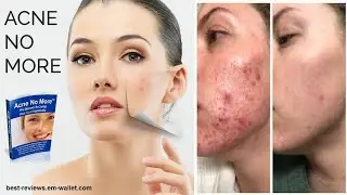 Acne No More Review - acne removal 2020