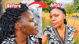 My Simple Skin Care Routine In My African Village//Acne Control!!