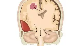 Brain Edema or Cerebral Edema ; Definition, Causes, Symptoms, Diagnosis, Treatment