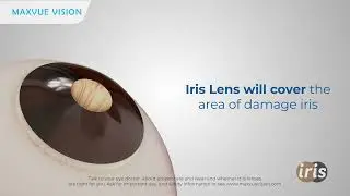Maxvue Vision Prosthetic Lens | Iris Lens