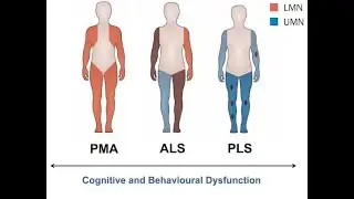 PLS Primary Lateral Sclerosis; progressive motor neuron disease, affects only upper motor neurons