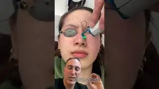 Treatment of Facial Redness