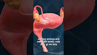 ওভারিয়ান ক্যান্সার কী? #WomenCancerAwareness #KnowOvarianCancer #DrKABMAbdullahAlHasan