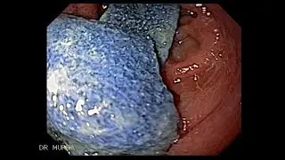 Endoscopia de Compresa Quir&uacute;rgica 