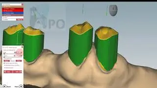 exocad  telescopic crown (12)