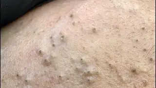 Корейский уход за кожей от Soko (для чувствительной кожи с рубцами от акне)