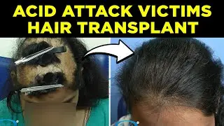 ✅ All About Surgery Scars | Acid attack victim & Burn Scars | By Dr Arvind Poswal✅