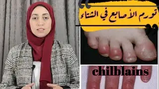 علاج تورم الأصابع في فصل الشتاء في خطوتين 👌🏻💯