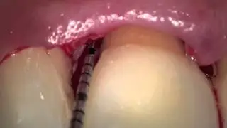 Minimally Invasive Regeneration (EMD)