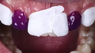 Injectable technique veneers,  13-23 MEDIT i700w