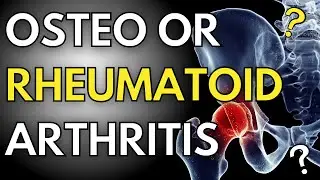 How To Tell If You Have Osteoarthritis Or Rheumatoid Arthritis? #arthritis