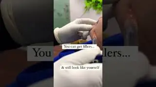 #fillers #botox #restylane #juvederm #shorts #viral #reels #viralvideo #youtubeshorts #love