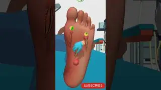 Foot pimple cleaning ASMR #asmr #doctor #treatment #viral #shortvideo #shorts #youtube