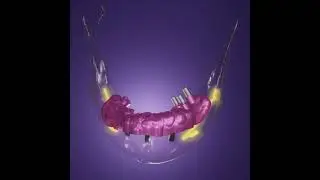 Nerve by pass in basal implant