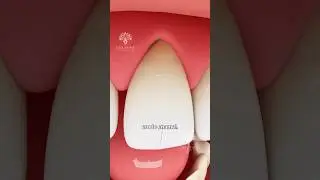 What Causes Teeth Sensitivity 🦷 Surgeon Reacts