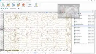 Revisão de EEG prolongado