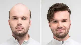 Custom made Hairpiece I Solution for baldness I Hairsystems Heydecke