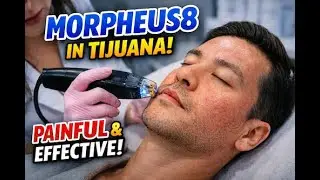 I Tried Morpheus8 in Tijuana &mdash; EndyMed vs Morpheus8 Results