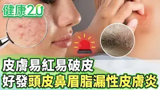 皮膚易紅易破皮 好發頭皮鼻眉多脂漏性皮膚炎【健康2.0分段】@tvbshealth20 EP3169-2 20260201 #鄭凱云#盧俊吉#蔡逸姍#吳明珠#洪素卿#林秋香
