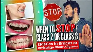 When to STOP Invisalign or Braces Class 2 or Class 3 Elastics