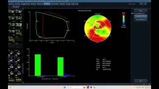 IQ 678  GWE MYOCARDIAL WORK EFFICIENCY LVEF LV GLS LV PSD ECHOCARDIOGRAPHY ECHOPAC ANALYSIS