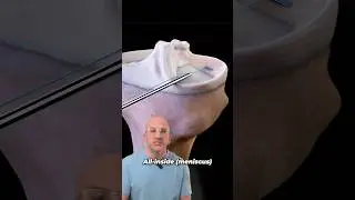 Ingenious Meniscus Tear Repair With Faster Recovery⁉️