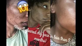 How I cleared my acne prone oily skin in less than 3months|| ACNE.ORG + pictures
