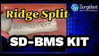 Ridge split system