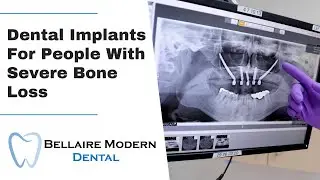 Dental Implants For People With Severe Bone Loss