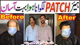 Hair Patch in Karachi | Hair Wigs | Hair Replacement for Men | Hair Patch for men in Pakistan