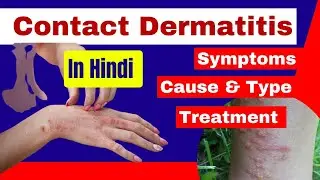 Contact dermatitis in hindi | irritant contact dermatitis | Allergic contact dermatitis | dermatitis