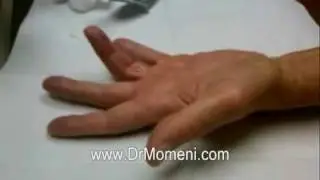 Xiaflex&reg; Injection for Dupuytren's Contracture of the Finger Joint
