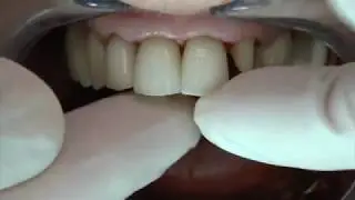 4 anteriors in allceramic