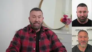Hair and Beard transplant results- 6 month hair transplant checkin with Este Medical
