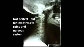 Can a reverse neck curve cause shoulder pain?
