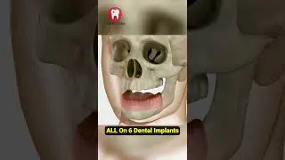All On 6 Dental Implants #shorts
