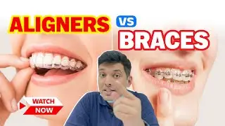 Aligners Vs Braces : Which Is Better For Teeth Alignment? Orthodontist In Gr Noida - Dr Ishan Singh
