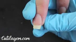 Cutilagem Perfeita usando a Cureta. Assista a Diferença