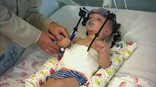 Toddler's head reattached to spine