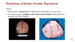 Male genital system Pathology | LEC 1