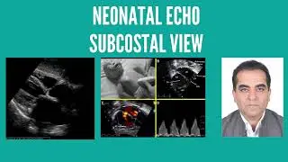 Subcostal view l Neonatal echo #pocus #echo