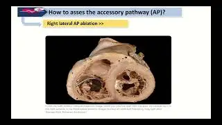 AVRT and accessory pathway: Nuts-and-Bolts