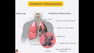 Pathogenesis of Coal Workers&rsquo; Pneumoconiosis or black lung disease