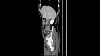 colon cancer(#applecore narrow)