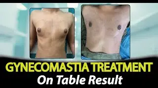 Gynecomastia Surgery Result | Male Chest Transformation | Rejuvena Cosmo Care Jaipur |