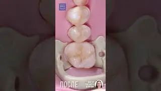 Анатомичная реставрация зуба 26. Soft Smile.