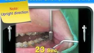 Impacted tooth L3