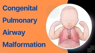 Congenital Pulmonary Airway Malformation (CPAM) : Causes, Symptoms, Diagnosis and Treatment
