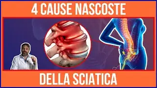 Ti SVELO il SEGRETO sulle 4 CAUSE della SCIATICA